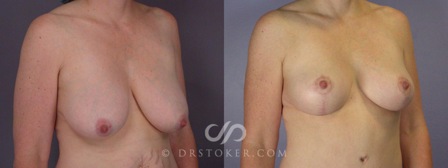 Before & After Tummy Tuck Case 240 View #11 View in Los Angeles, CA