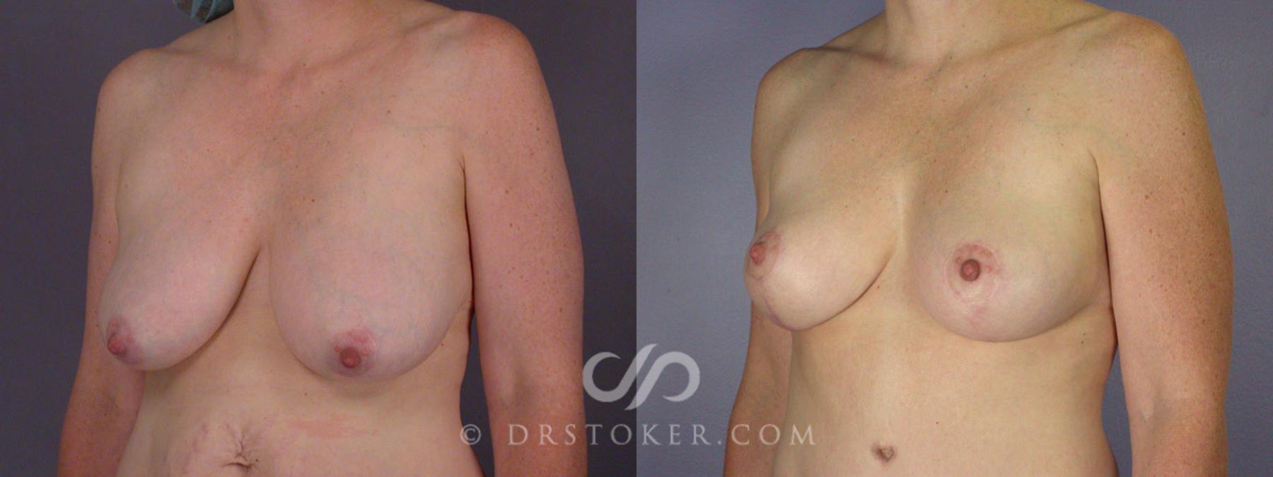 Before & After Breast Lift Case 240 View #12 View in Los Angeles, CA