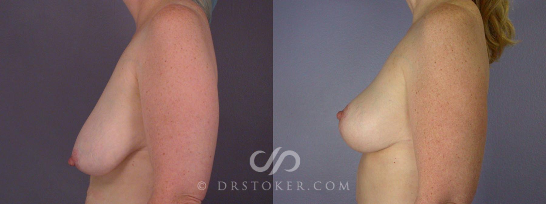 Before & After Breast Lift Case 240 View #14 View in Los Angeles, CA