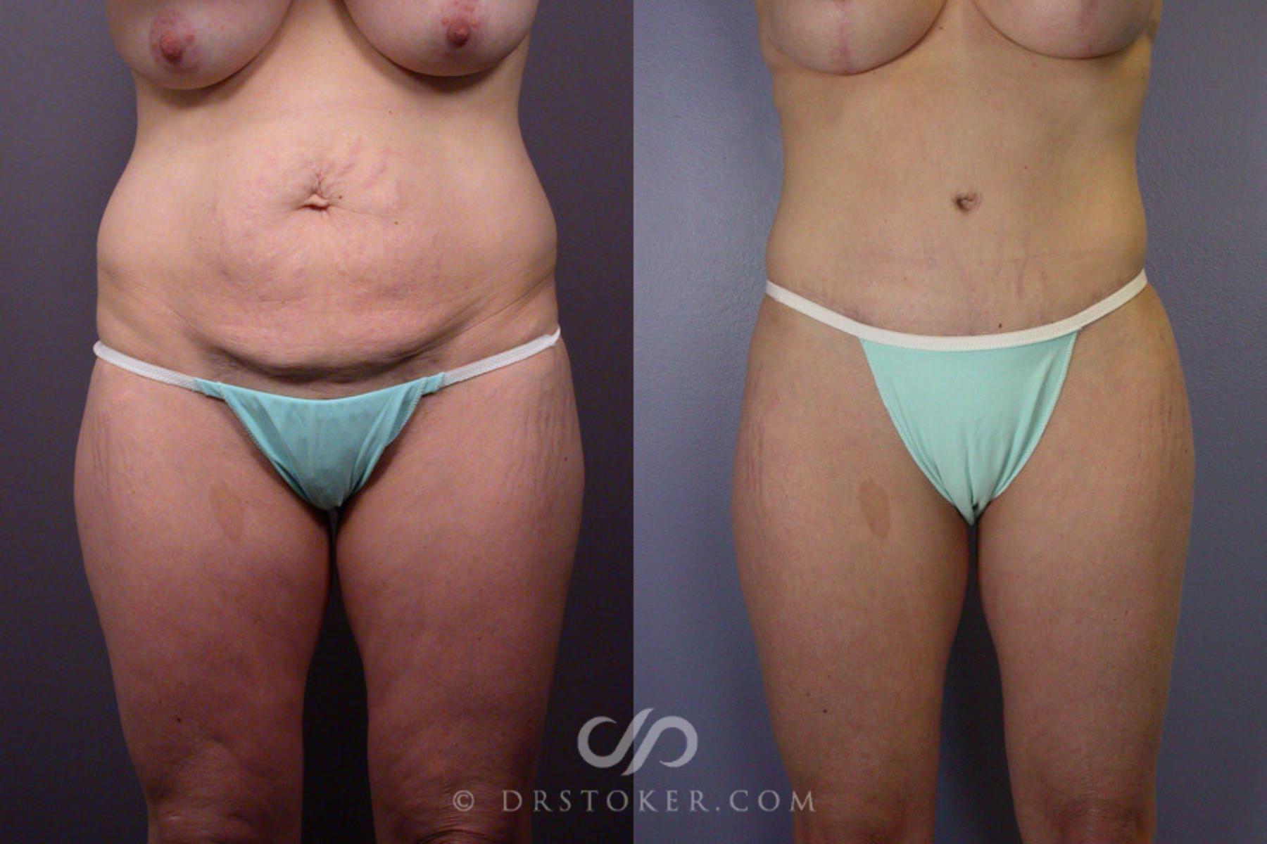 Before & After Tummy Tuck Case 240 View #2 View in Los Angeles, CA