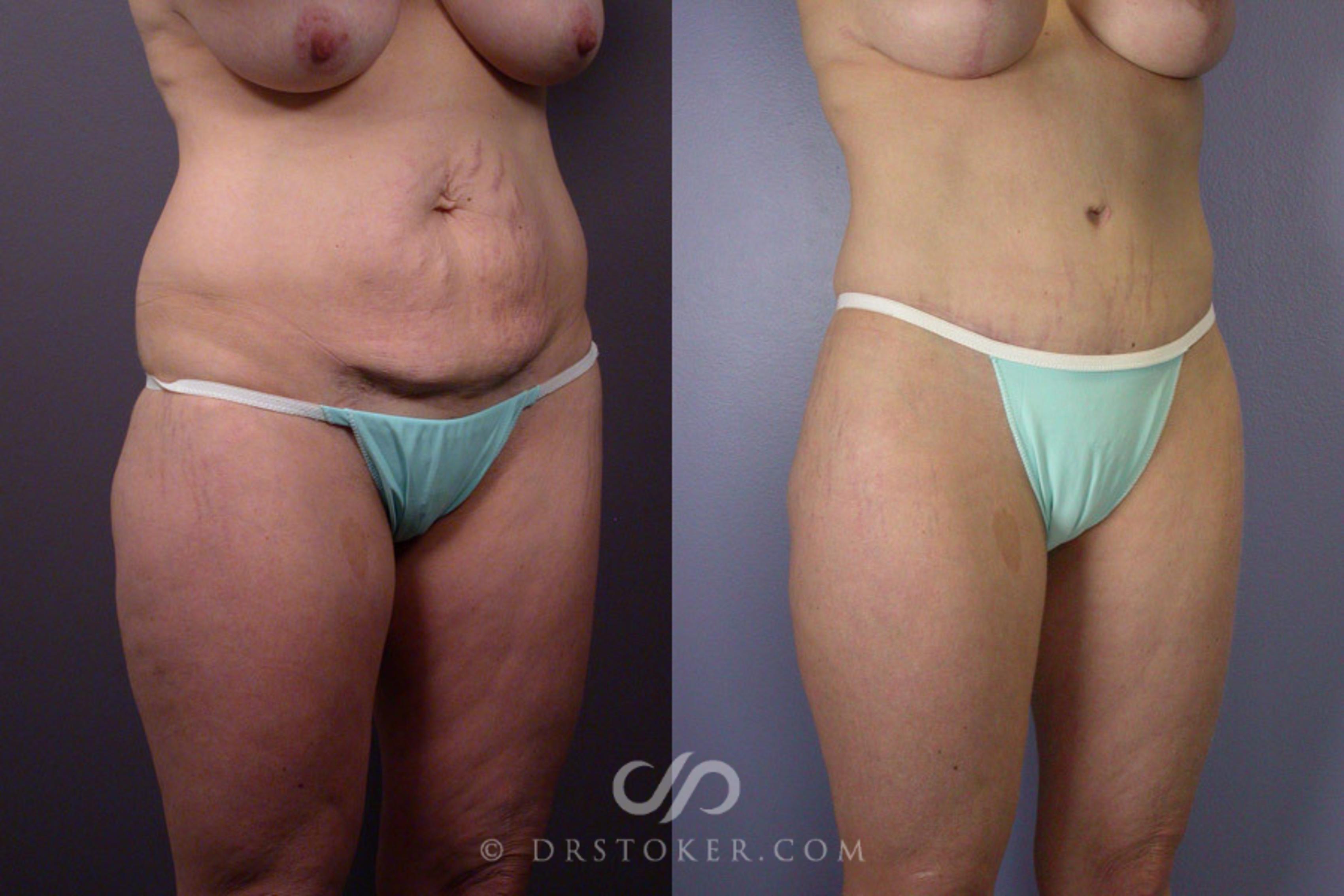 Before & After Breast Lift Case 240 View #3 View in Los Angeles, CA