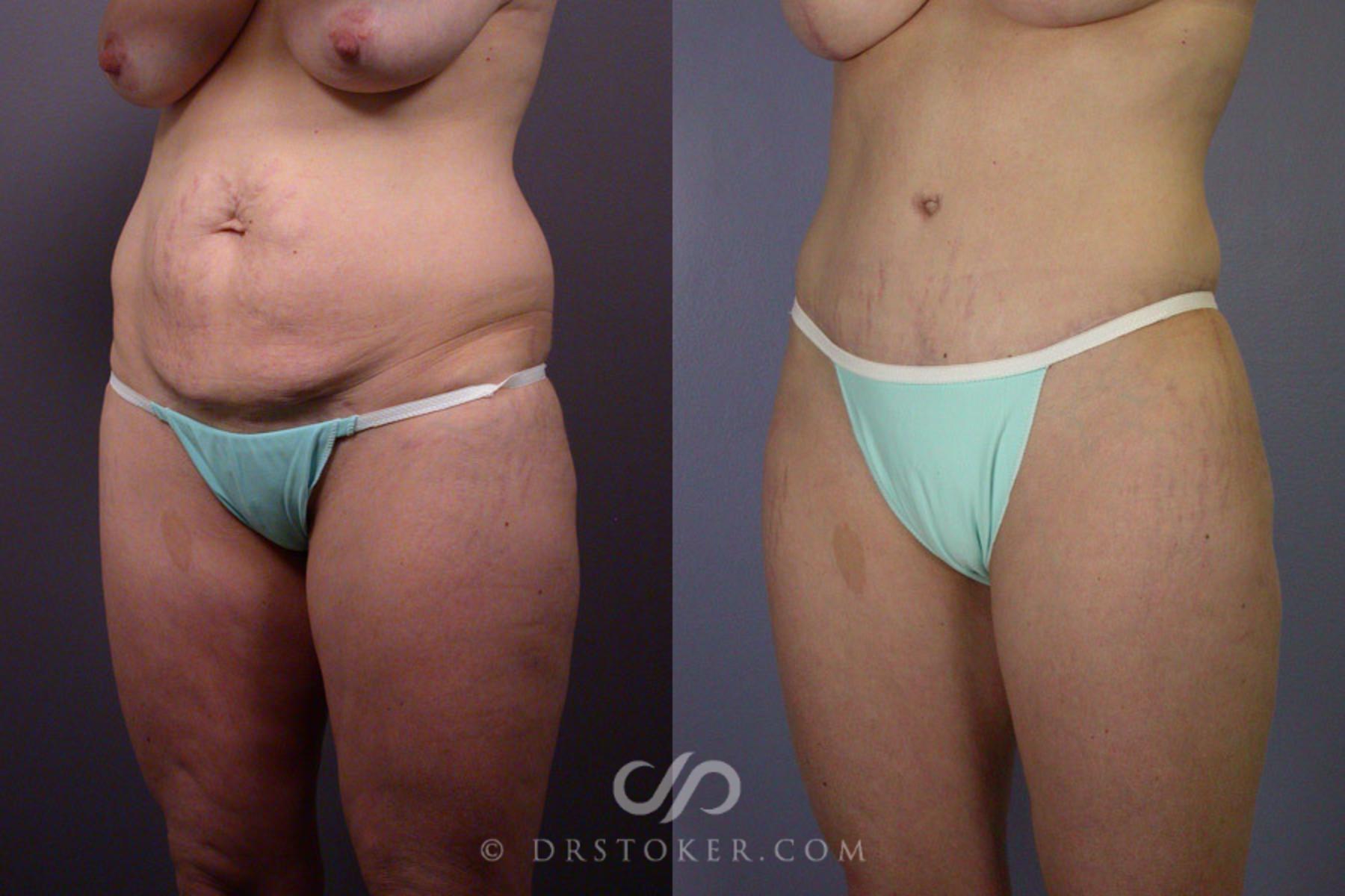 Before & After Tummy Tuck Case 240 View #4 View in Los Angeles, CA