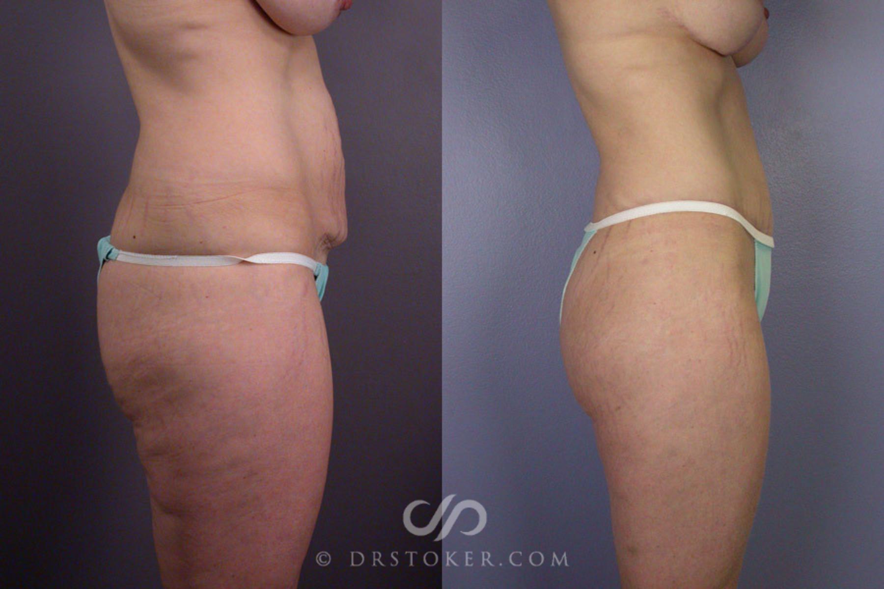 Before & After Breast Lift Case 240 View #5 View in Los Angeles, CA