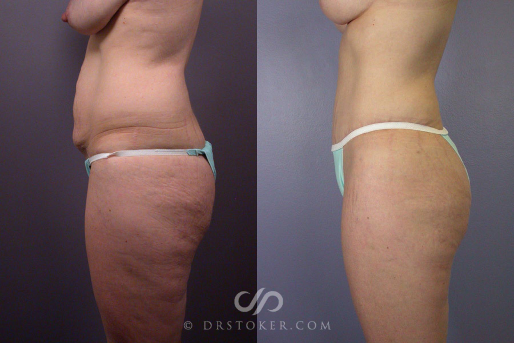Before & After Tummy Tuck Case 240 View #6 View in Los Angeles, CA