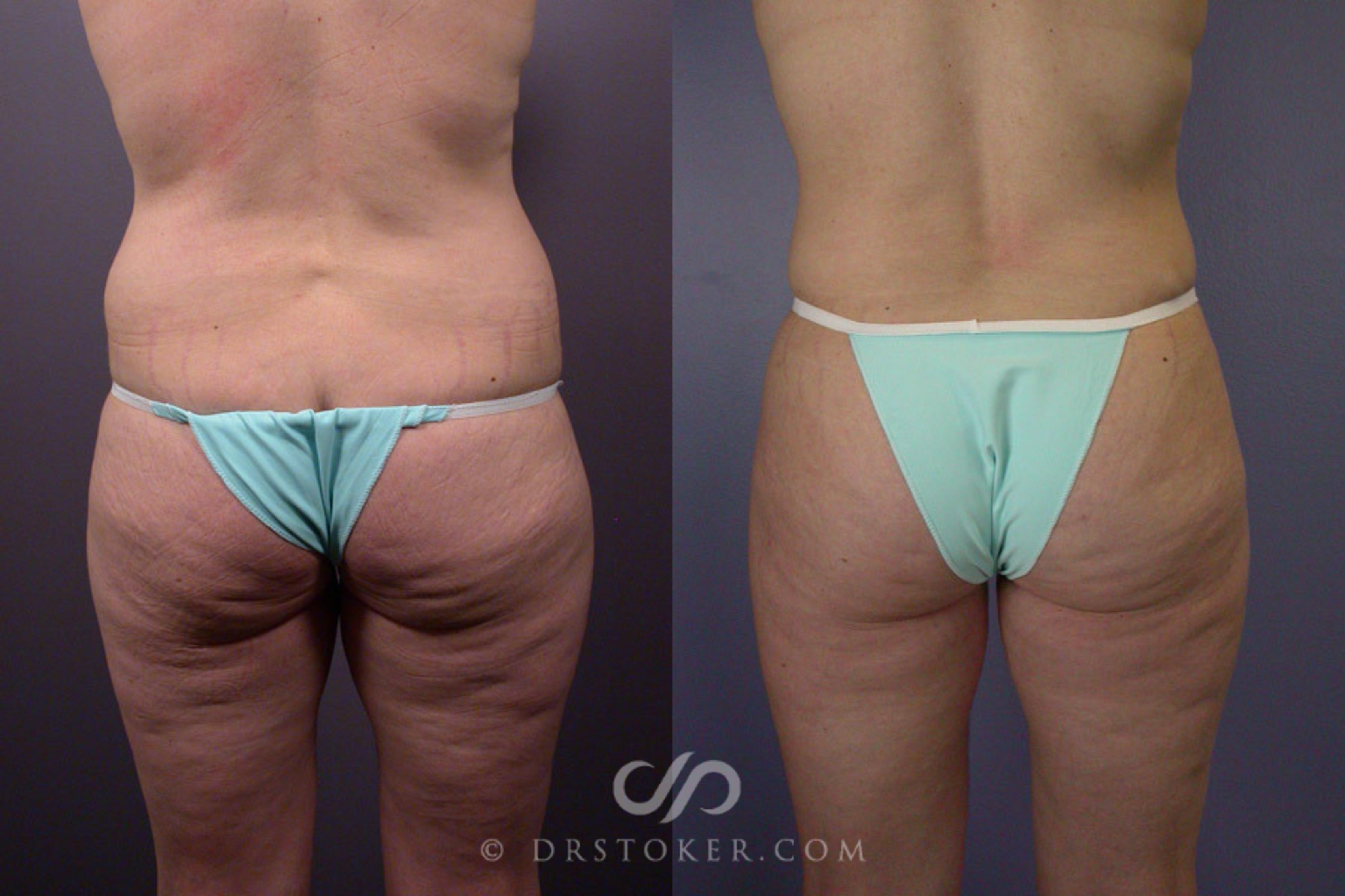 Before & After Breast Lift Case 240 View #7 View in Los Angeles, CA