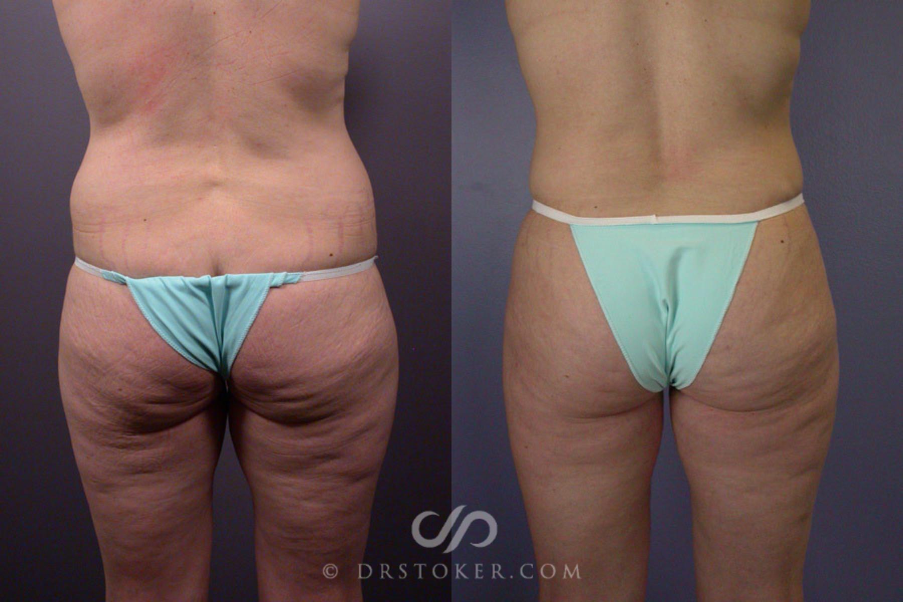 Before & After Tummy Tuck Case 240 View #7 View in Los Angeles, CA
