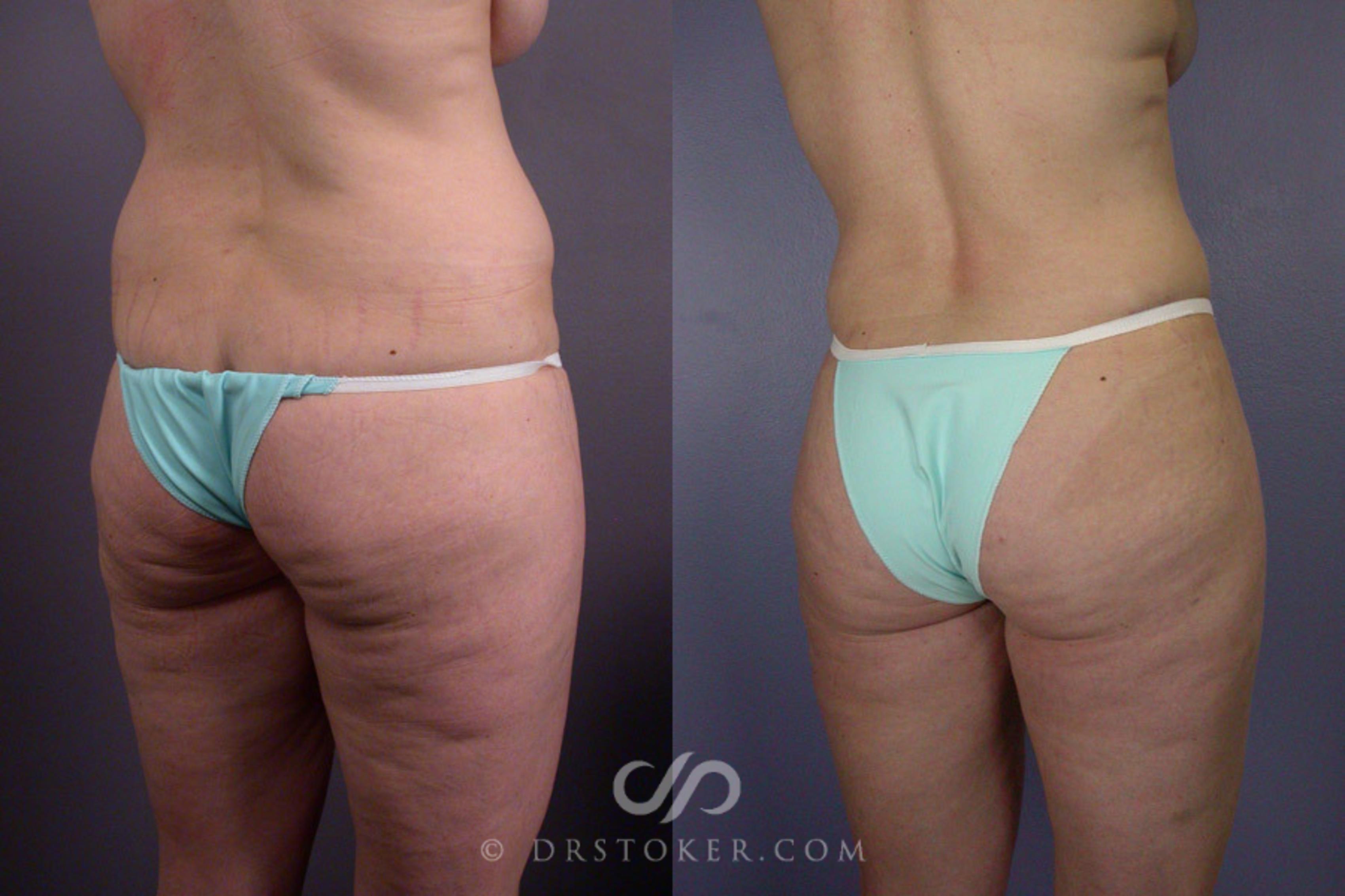 Before & After Breast Lift Case 240 View #8 View in Los Angeles, CA