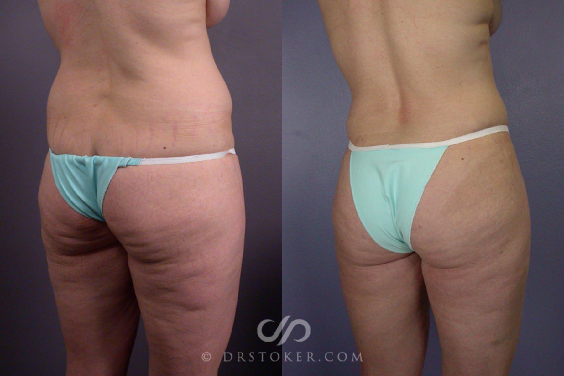 Before & After Breast Lift Case 240 View #8 View in Los Angeles, CA