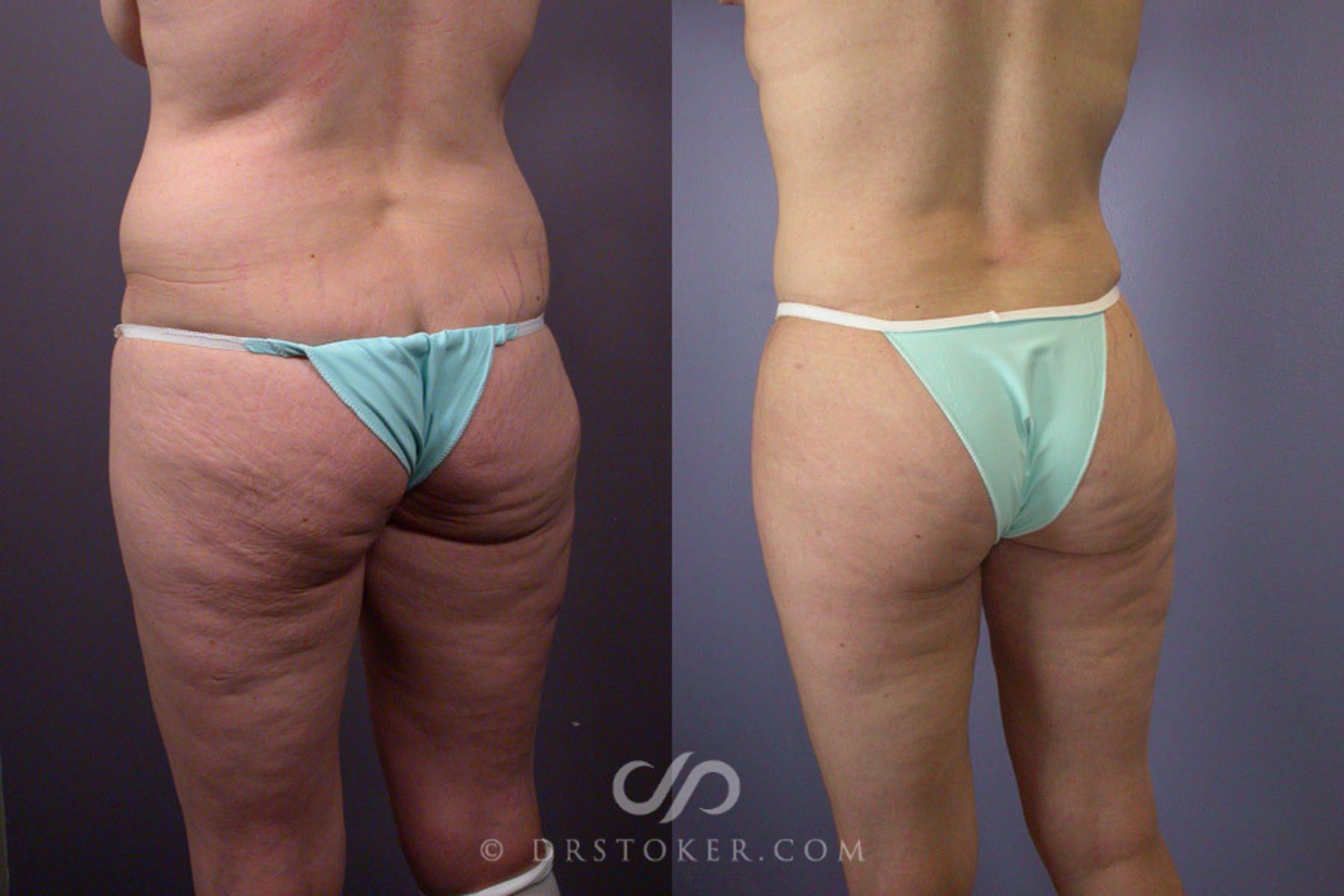 Before & After Tummy Tuck Case 240 View #9 View in Los Angeles, CA
