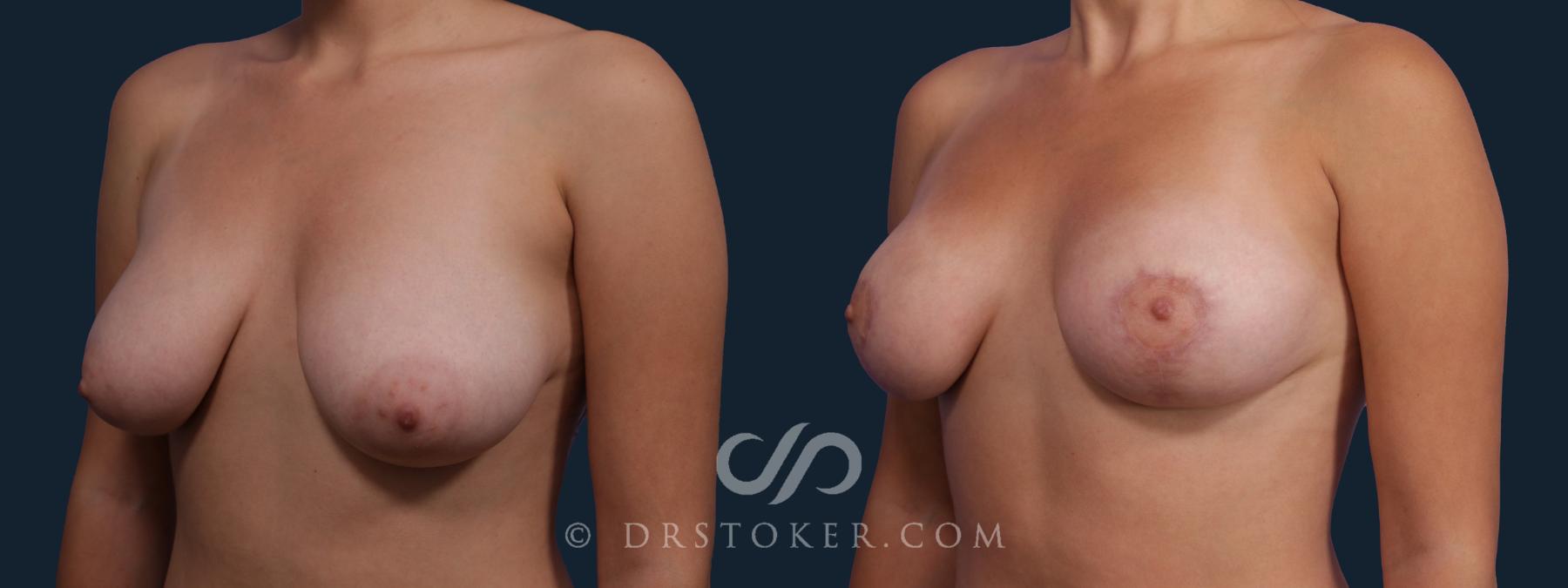 Before & After Breast Lift Case 2636 Left Oblique View in Los Angeles, CA