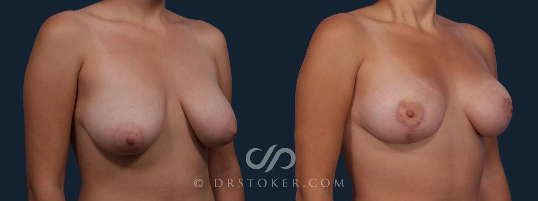 Before & After Breast Lift Case 2636 Right Oblique View in Los Angeles, CA