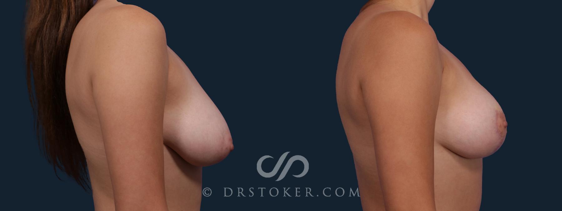 Before & After Breast Lift Case 2636 Right Side View in Los Angeles, CA