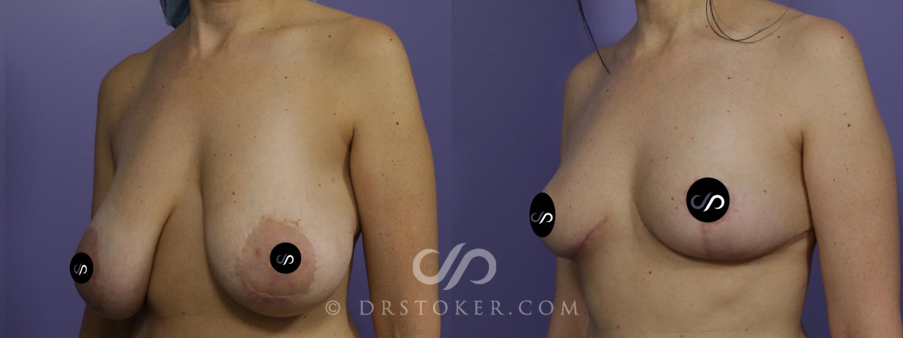 Before & After Breast Lift Case 2673 Left Oblique View in Los Angeles, CA