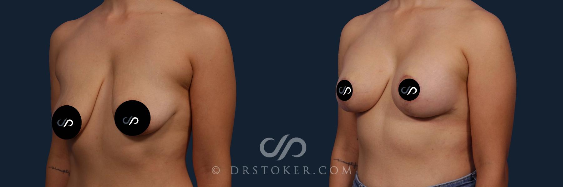 Before & After Breast Lift Case 2678 Left Oblique View in Los Angeles, CA
