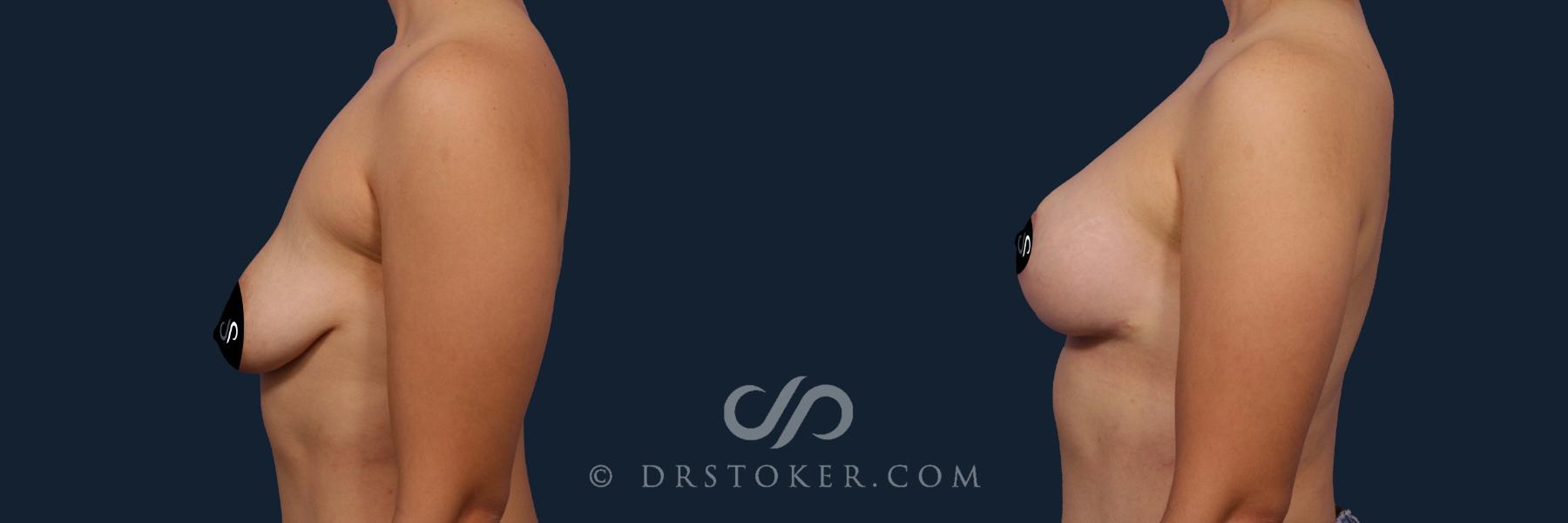 Before & After Breast Lift Case 2678 Left Side View in Los Angeles, CA