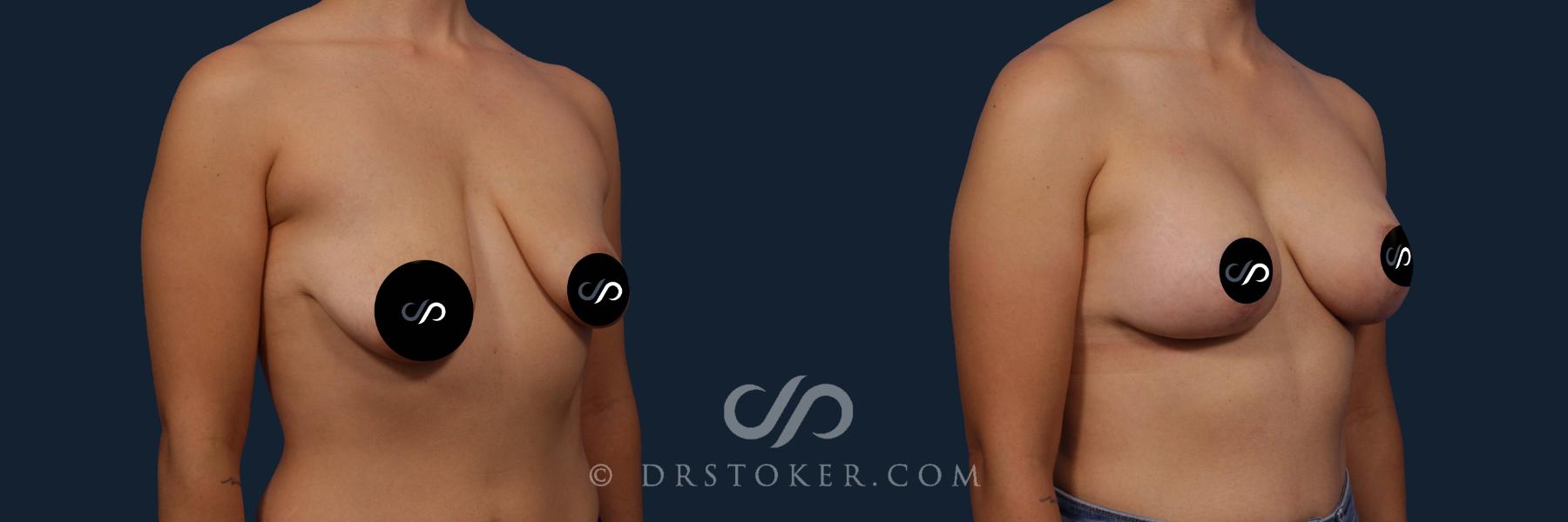 Before & After Breast Lift Case 2678 Right Oblique View in Los Angeles, CA