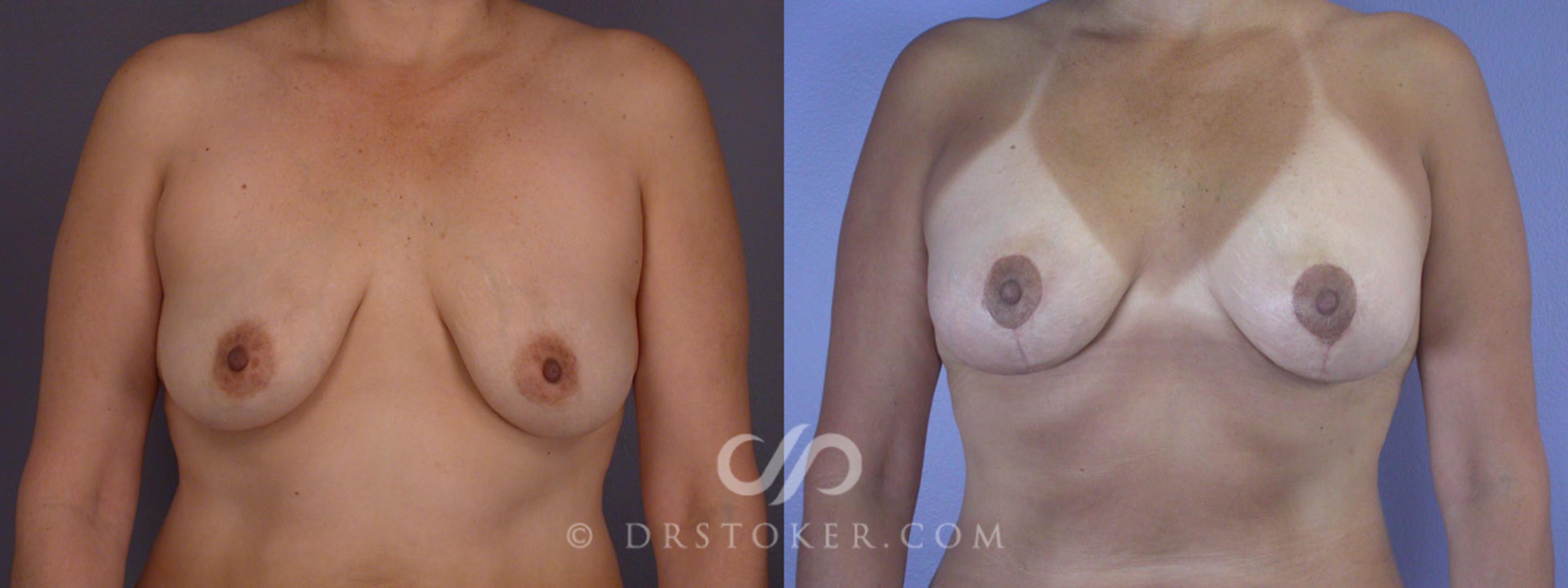 Before & After Breast Lift Case 282 View #1 View in Los Angeles, CA