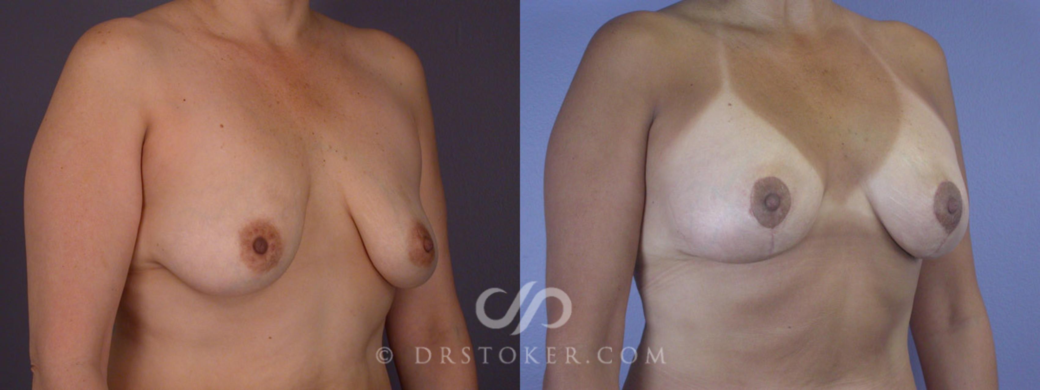 Before & After Breast Lift Case 282 View #2 View in Los Angeles, CA