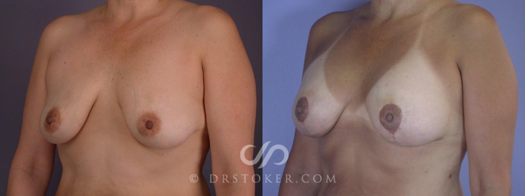 Before & After Breast Asymmetry Correction Case 282 View #3 View in Los Angeles, CA
