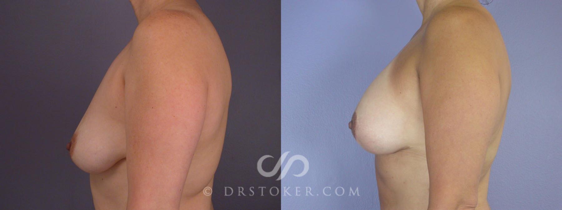 Before & After Breast Lift Case 282 View #4 View in Los Angeles, CA