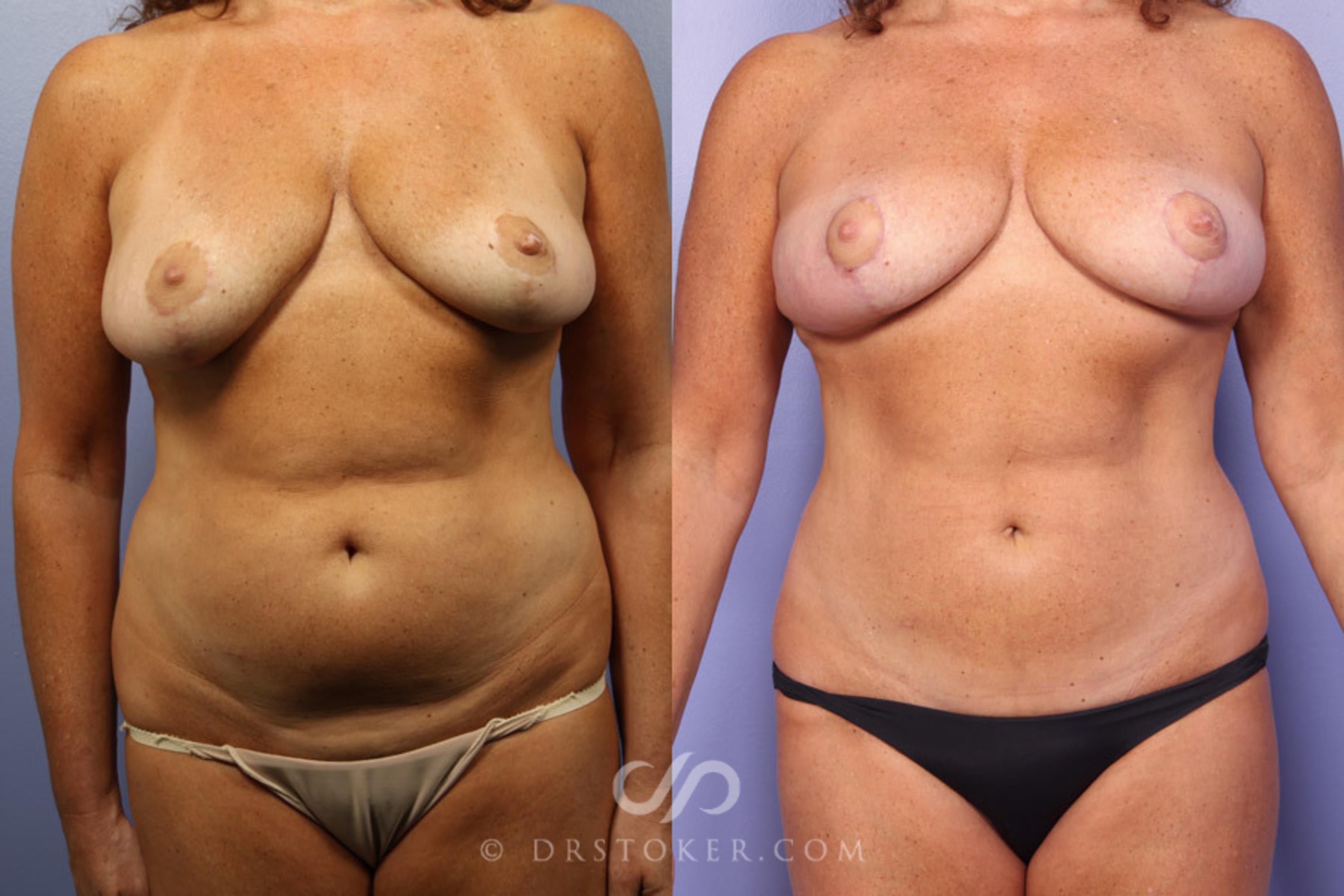 Before & After Breast Lift Case 301 View #1 View in Los Angeles, CA