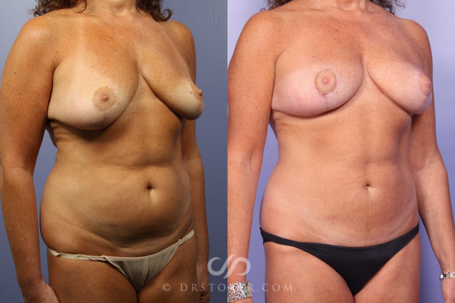 Before & After Breast Lift Case 301 View #2 View in Los Angeles, CA