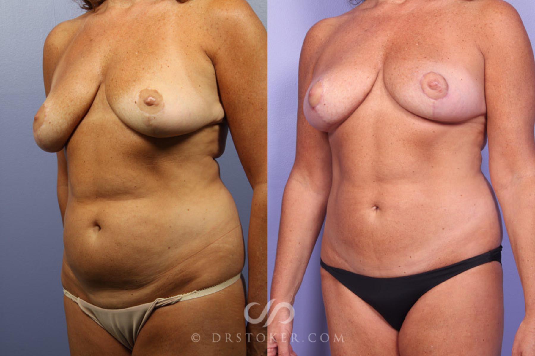 Before & After Mommy Makeover Case 301 View #3 View in Los Angeles, CA