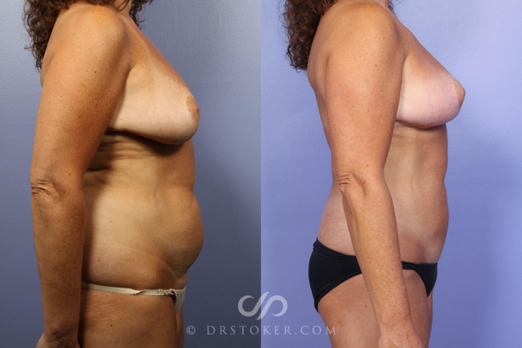 Before & After Mommy Makeover Case 301 View #4 View in Los Angeles, CA