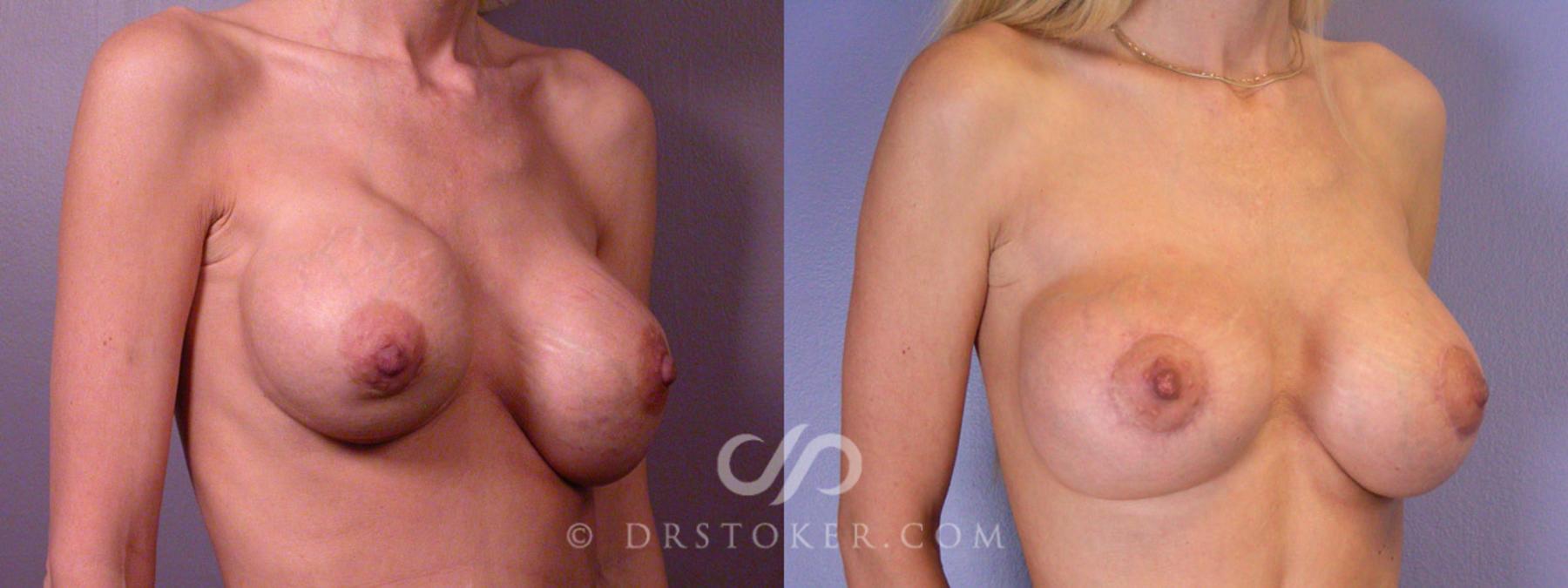 Before & After Breast Lift Case 314 View #2 View in Los Angeles, CA