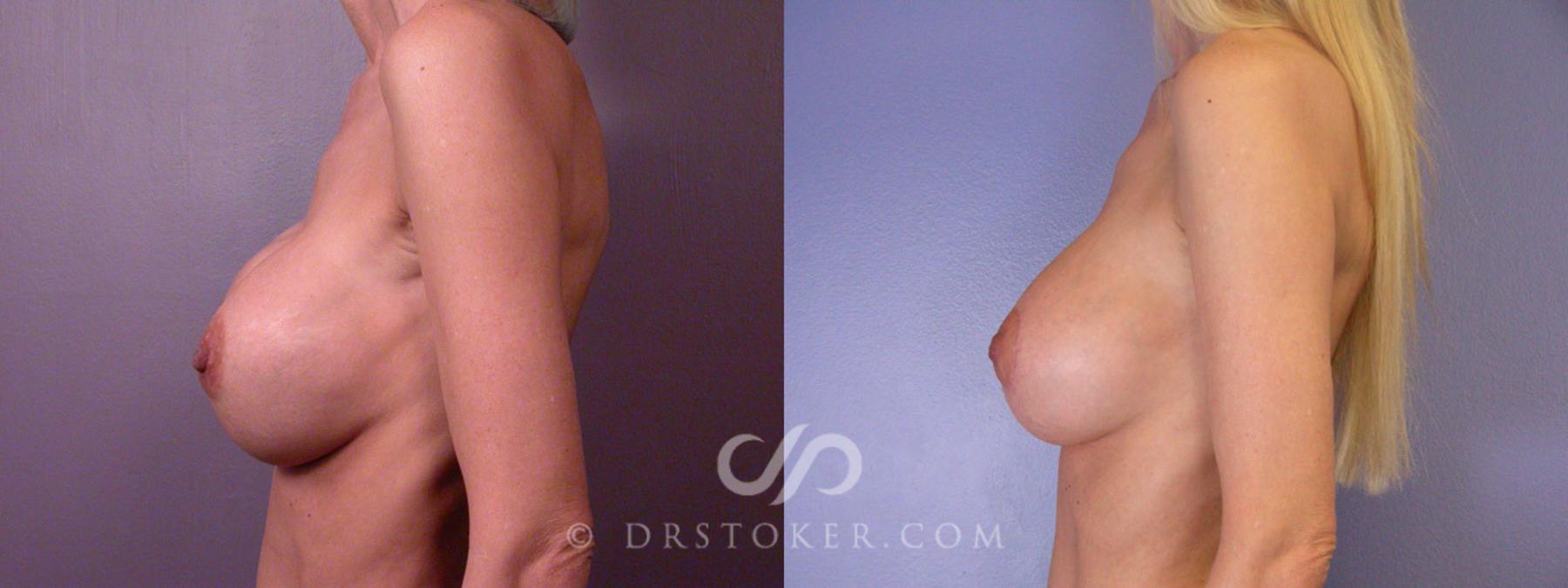 Before & After Breast Implant Correction Case 314 View #5 View in Los Angeles, CA