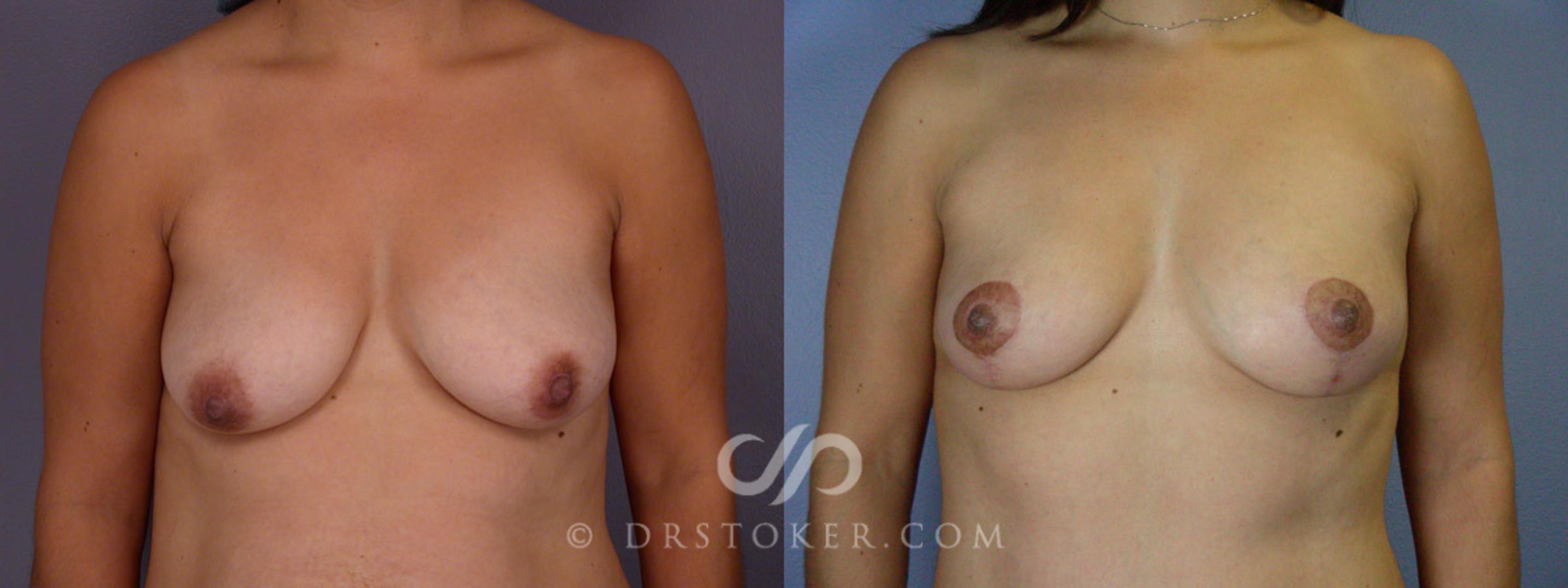 Before & After Breast Lift Case 316 View #1 View in Los Angeles, CA
