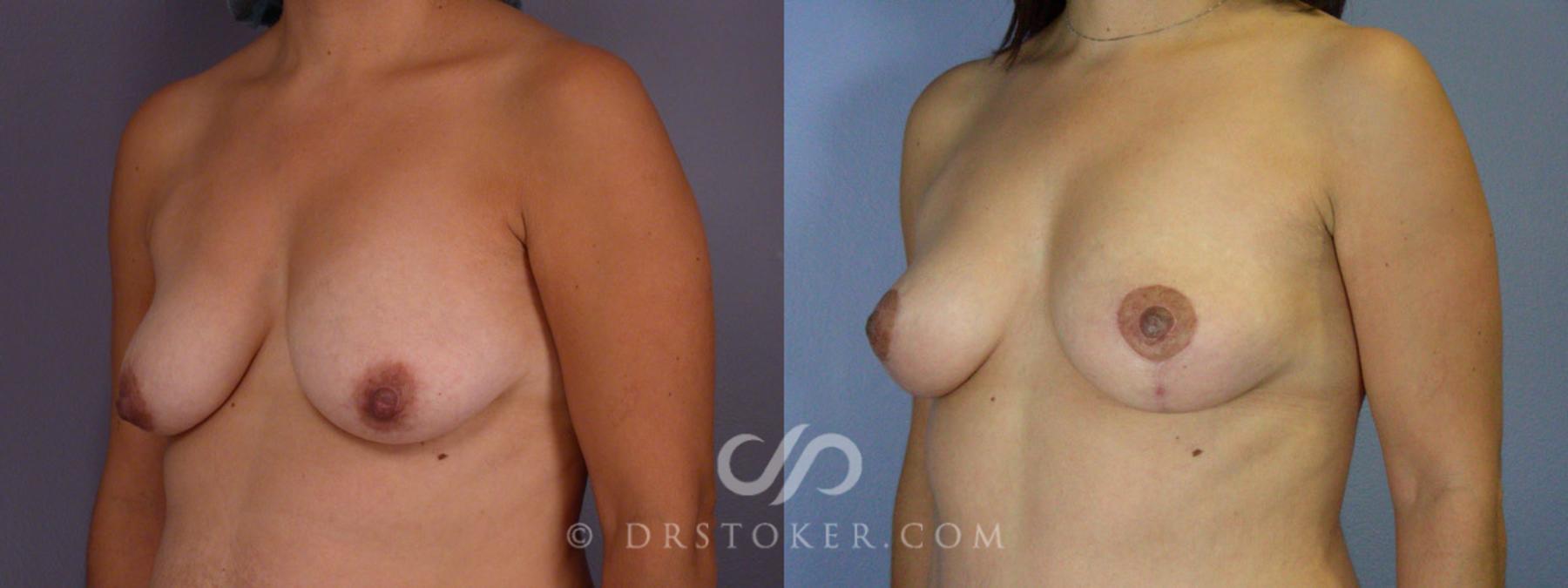 Before & After Breast Lift Case 316 View #3 View in Los Angeles, CA