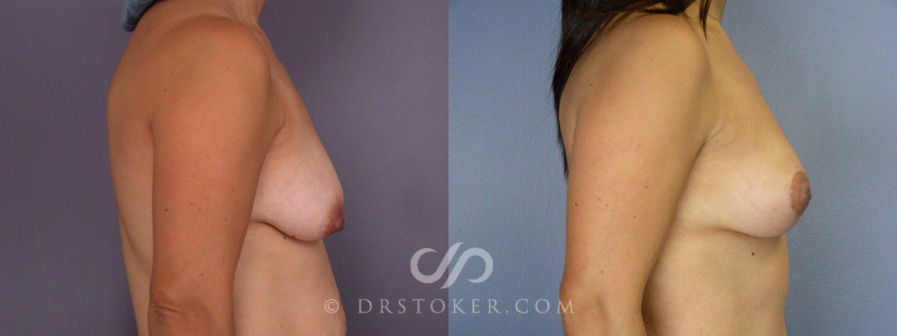 Before & After Breast Lift Case 316 View #4 View in Los Angeles, CA