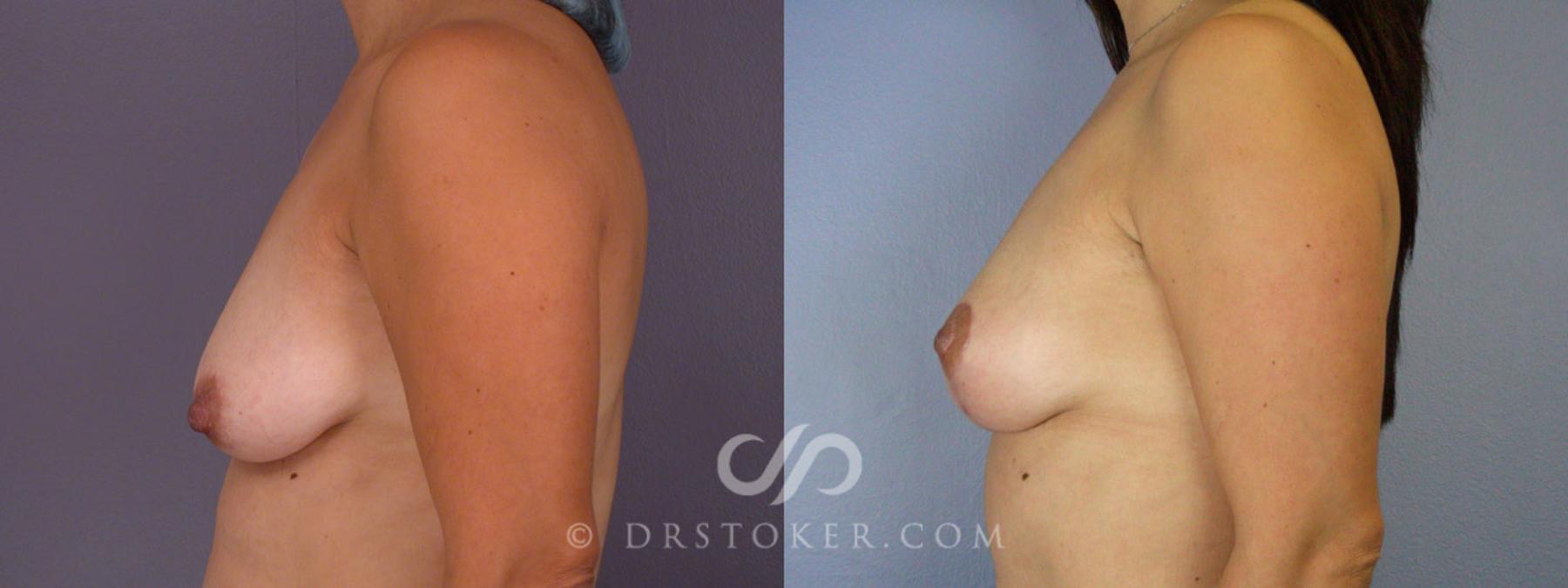 Before & After Breast Lift Case 316 View #5 View in Los Angeles, CA