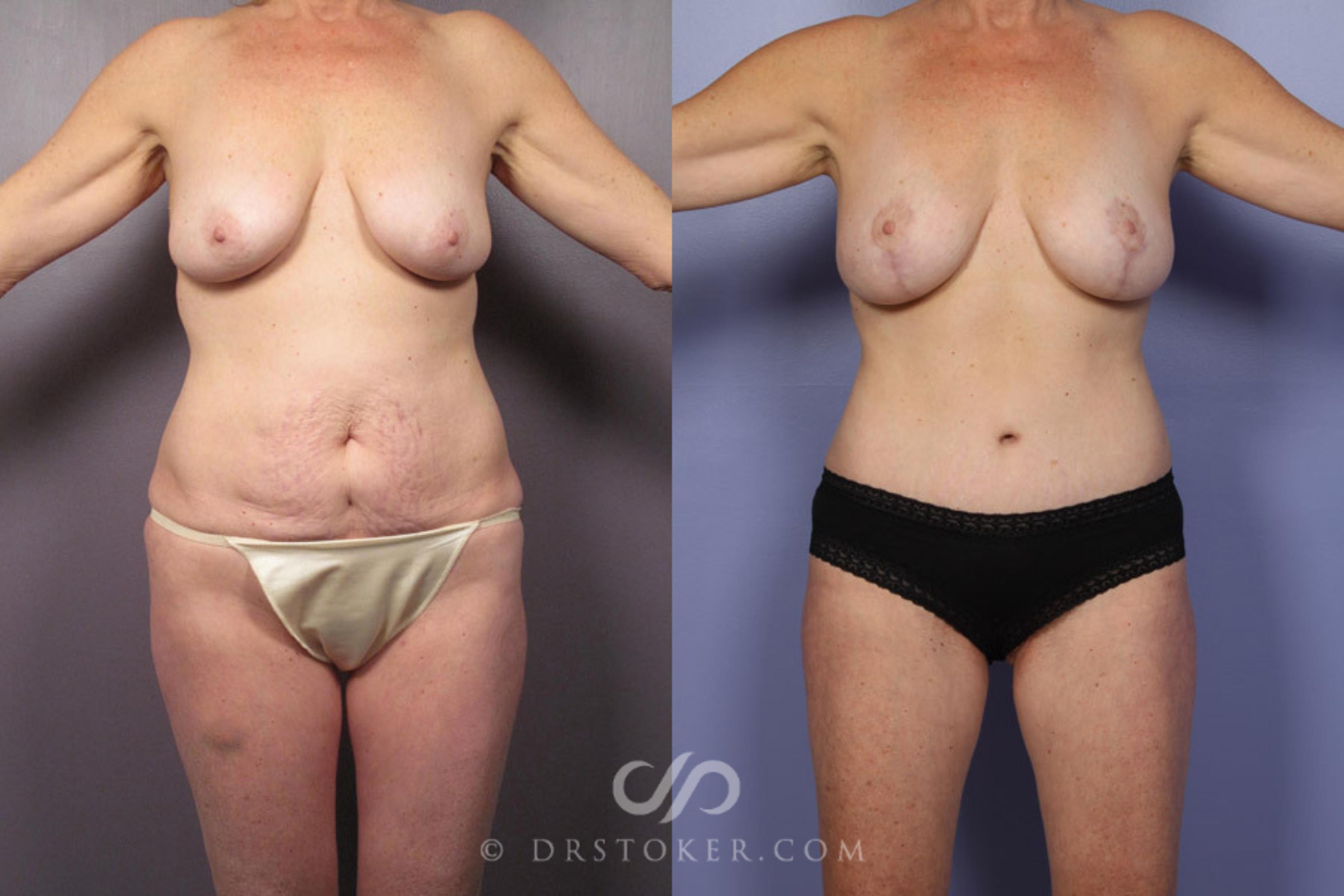 Before & After Tummy Tuck Case 337 View #1 View in Los Angeles, CA