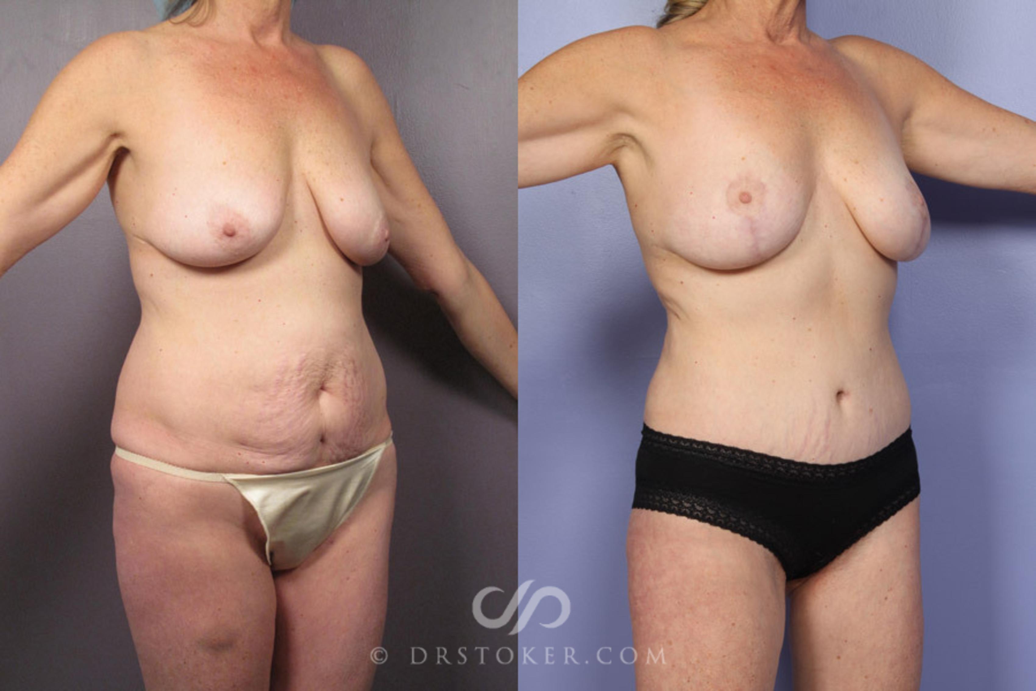 Before & After Breast Lift Case 337 View #2 View in Los Angeles, CA