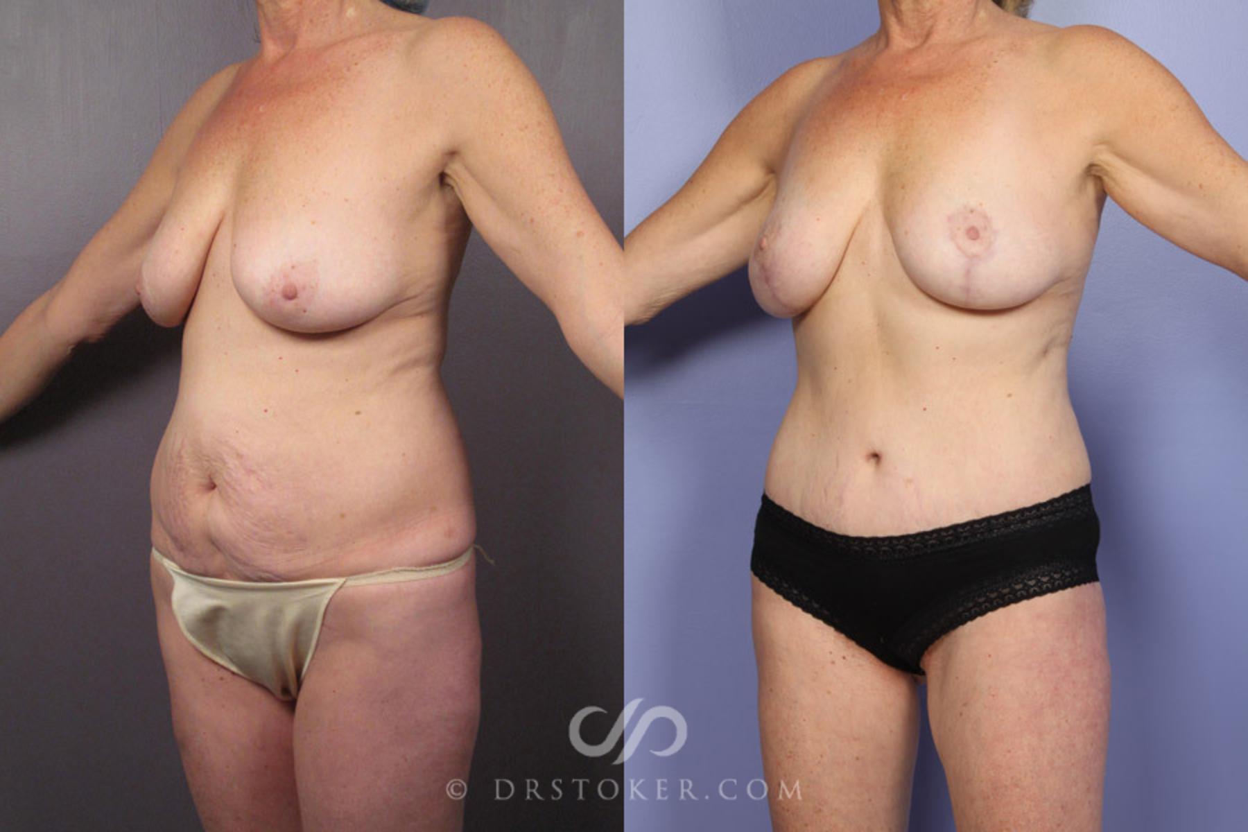 Before & After Breast Lift Case 337 View #3 View in Los Angeles, CA