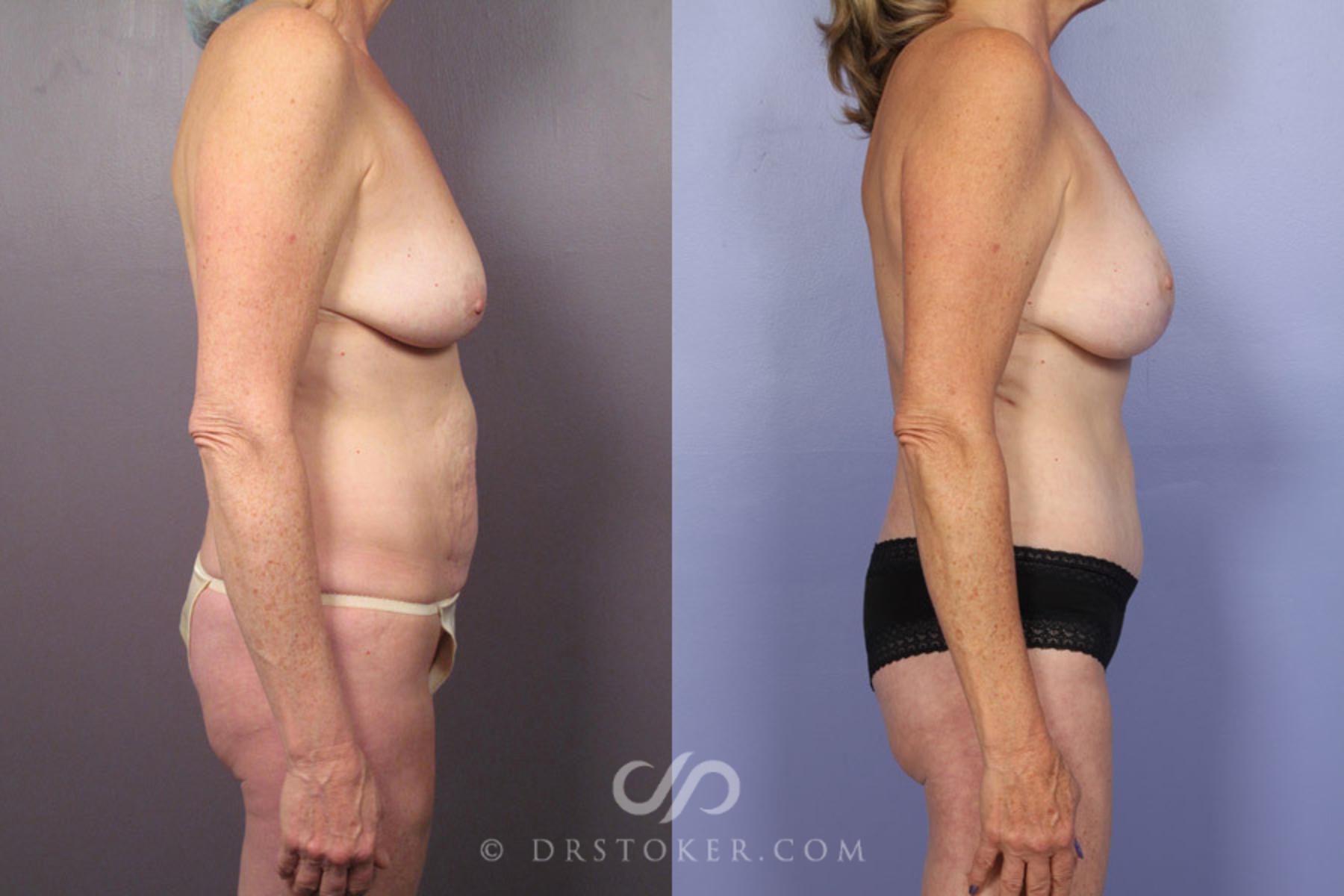 Before & After Tummy Tuck Case 337 View #4 View in Los Angeles, CA