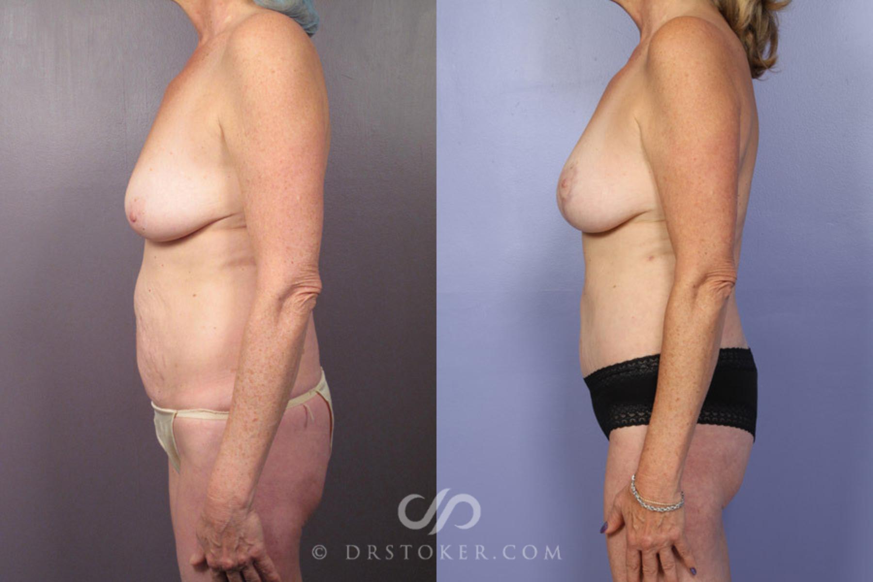 Before & After Tummy Tuck Case 337 View #5 View in Los Angeles, CA