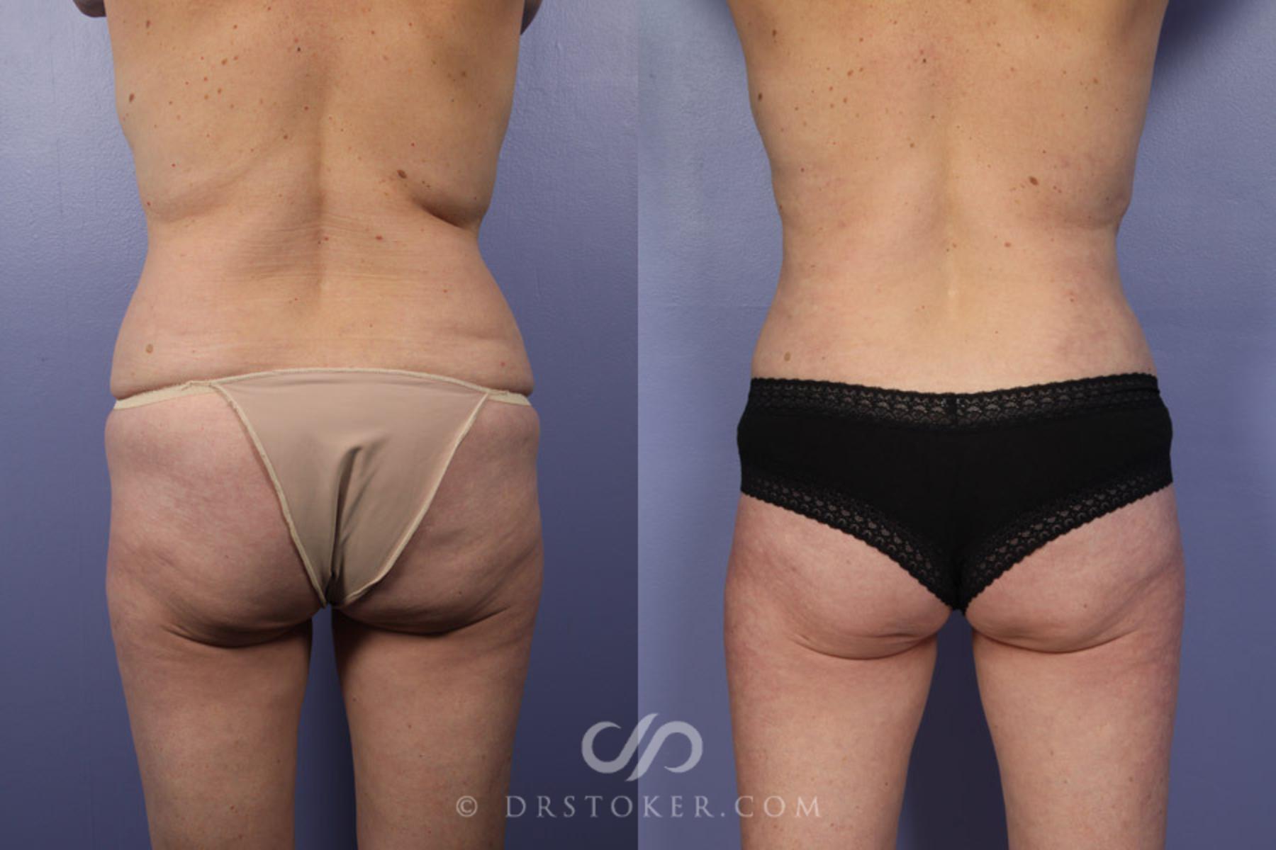 Before & After Breast Lift Case 337 View #6 View in Los Angeles, CA