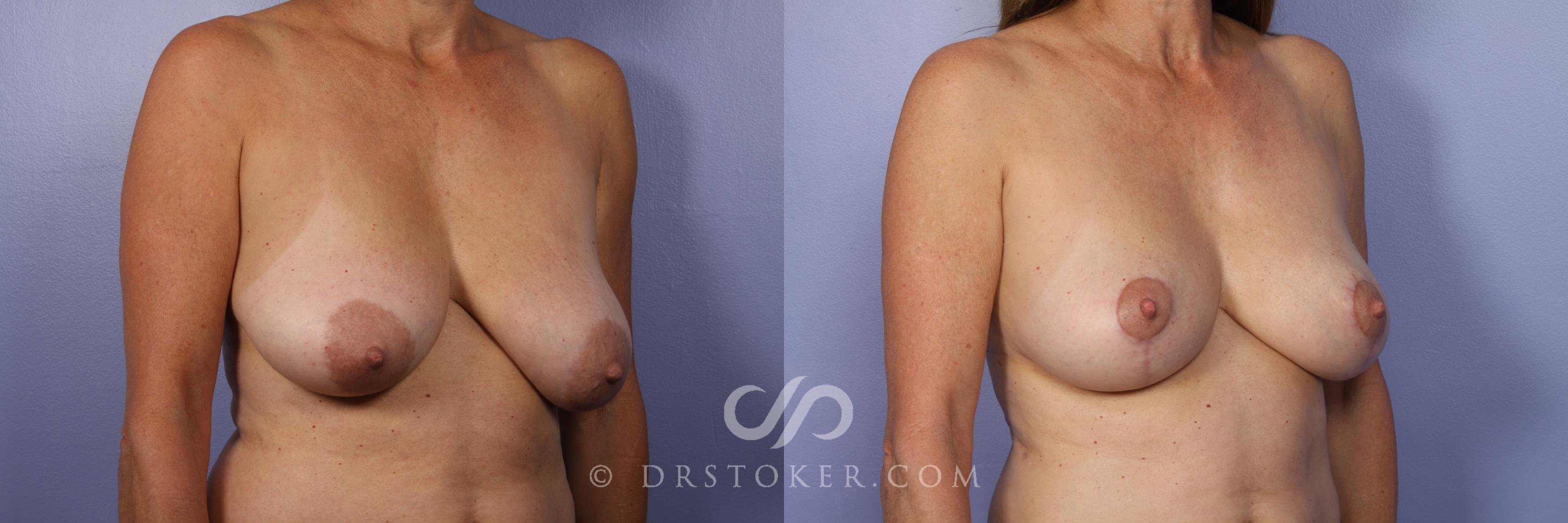 Before & After Breast Reduction (for Women) Case 392 View #2 View in Los Angeles, CA