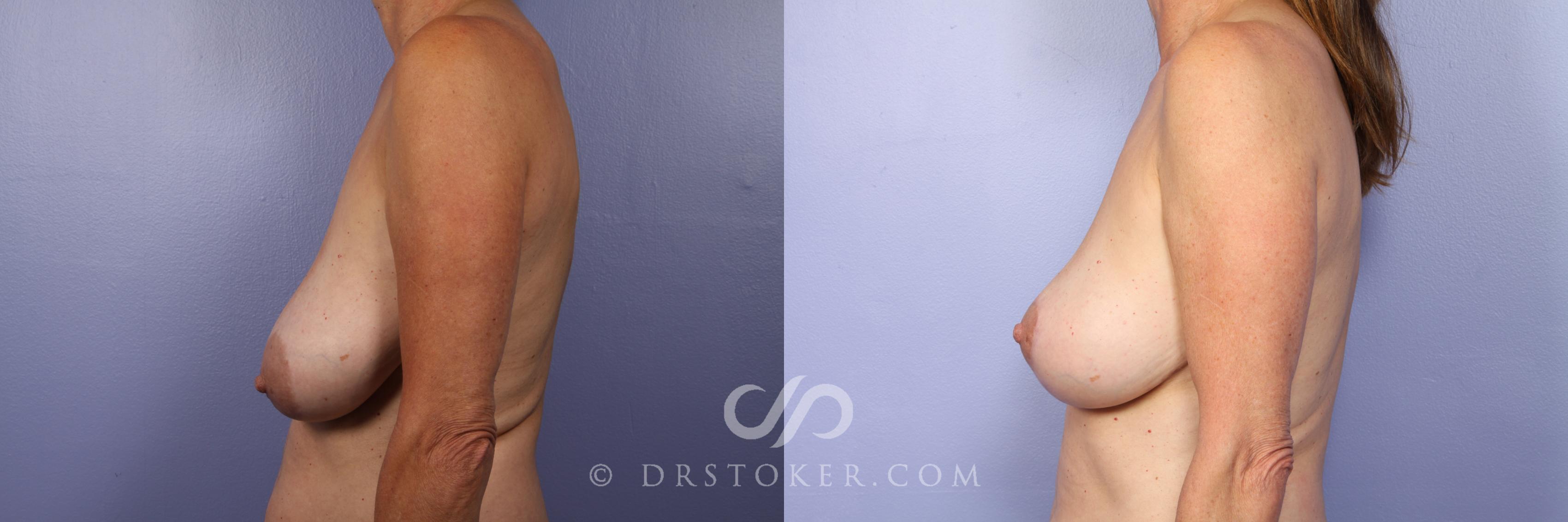 Before & After Breast Lift Case 392 View #4 View in Los Angeles, CA