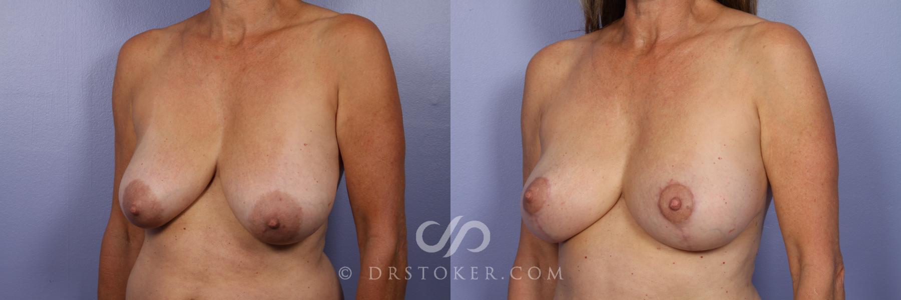 Before & After Breast Reduction (for Women) Case 392 View #5 View in Los Angeles, CA