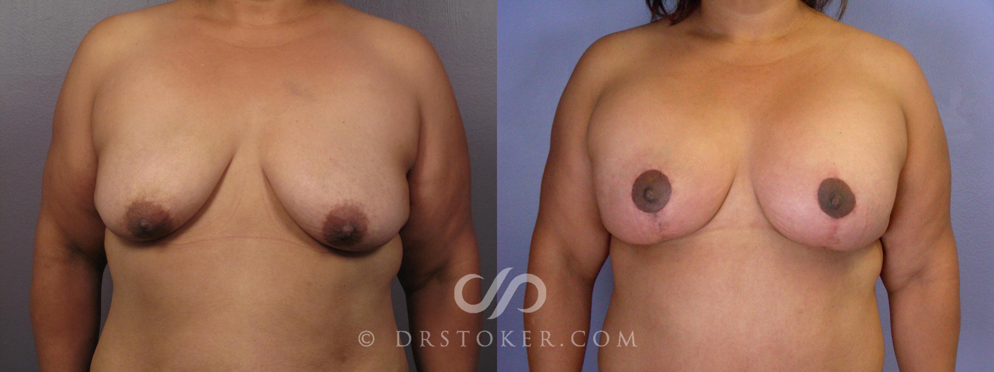 Before & After Breast Lift Case 404 View #1 View in Los Angeles, CA