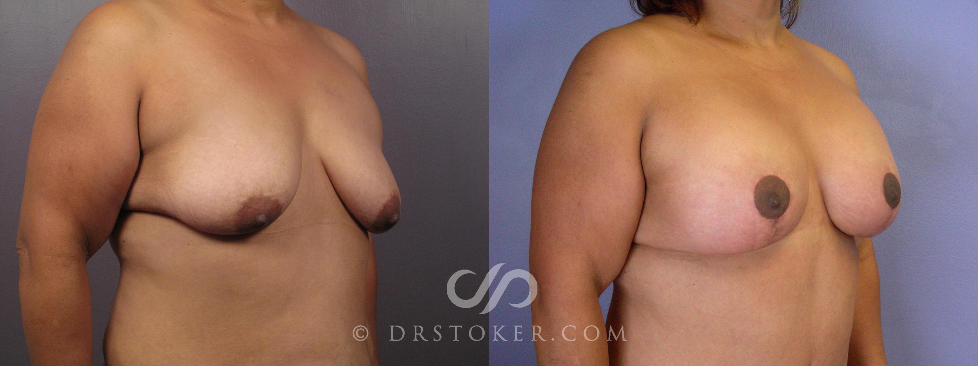 Before & After Breast Lift Case 404 View #2 View in Los Angeles, CA