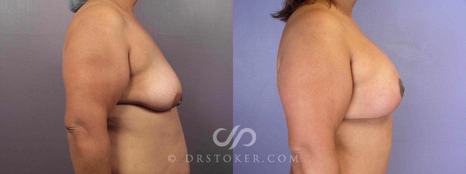 Before & After Breast Augmentation with Lift Case 404 View #3 View in Los Angeles, CA