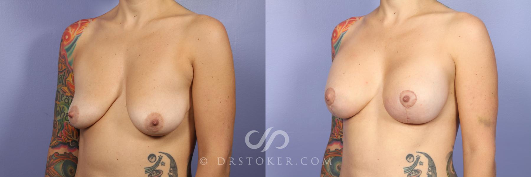 Before & After Breast Lift Case 409 View #2 View in Los Angeles, CA