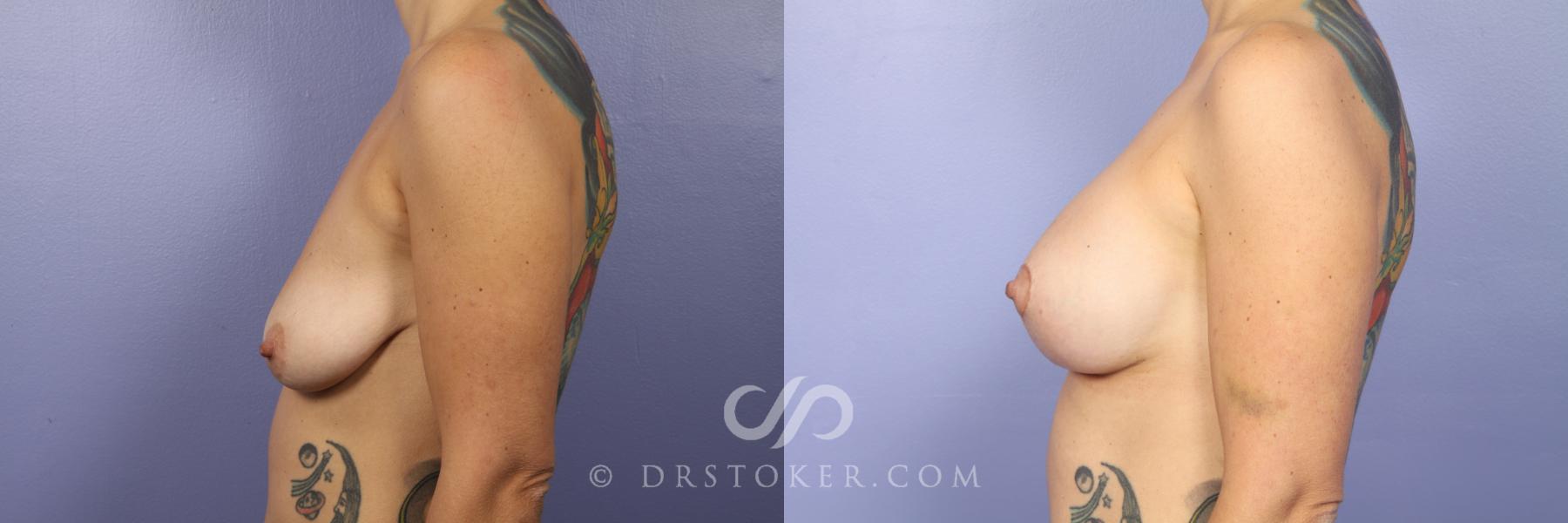 Before & After Breast Asymmetry Correction Case 409 View #3 View in Los Angeles, CA