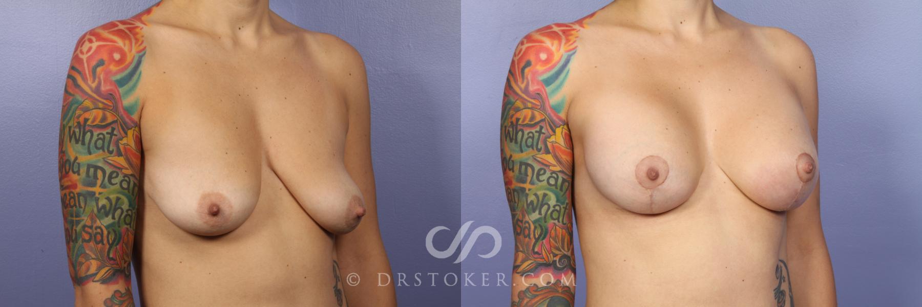 Before & After Breast Augmentation with Lift Case 409 View #4 View in Los Angeles, CA