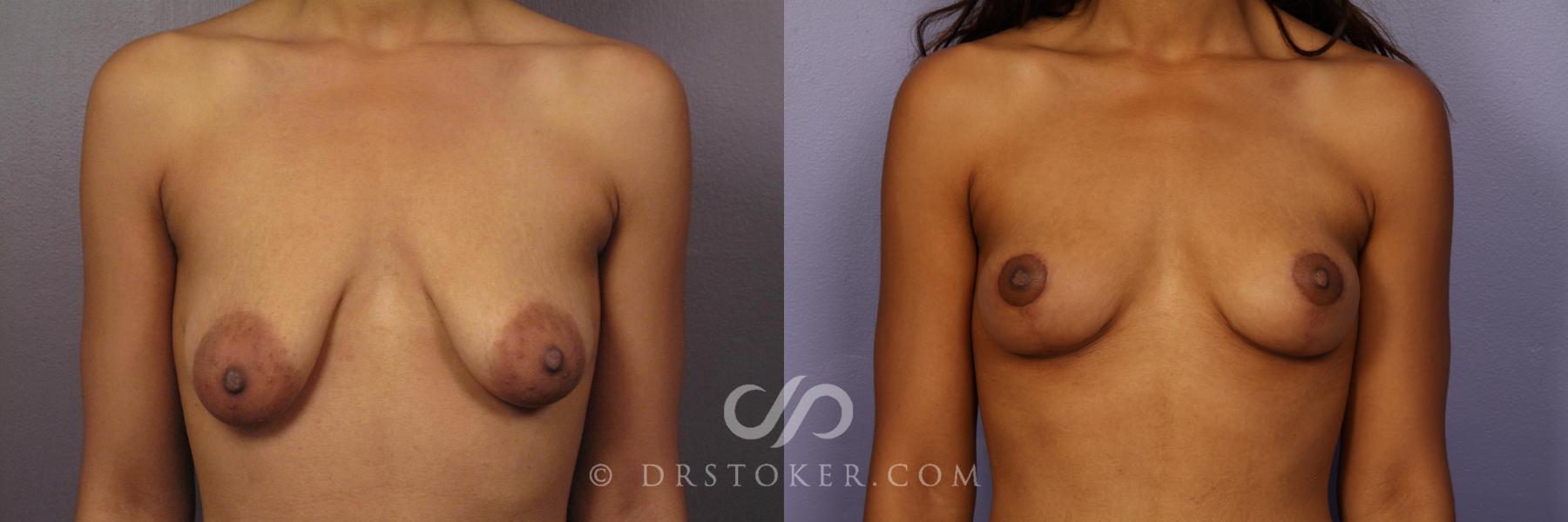 Before & After Breast Lift Case 426 View #1 View in Los Angeles, CA